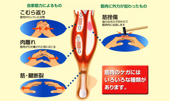 肉離れとはなにか？