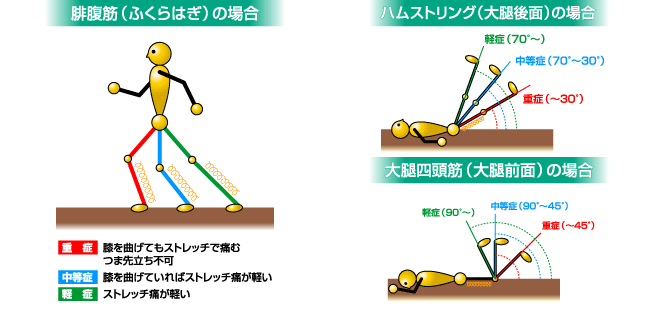 肉離れは３段階に分けられます