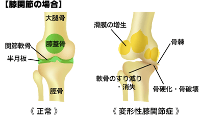 膝関節の場合