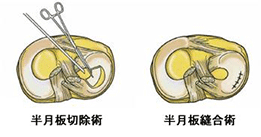 半月板損傷に対しての一般的な考え方