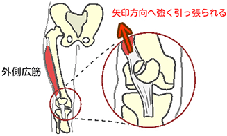 外側広筋が引っ張っている