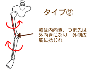 お皿の向きと膝関節の捻じれ