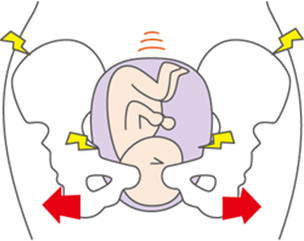 産後の骨盤矯正