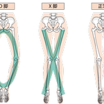 脚の捻じれは大きな原因となる